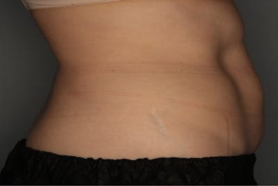 CoolSculpting Before & After Gallery - Patient 55475020 - Image 2