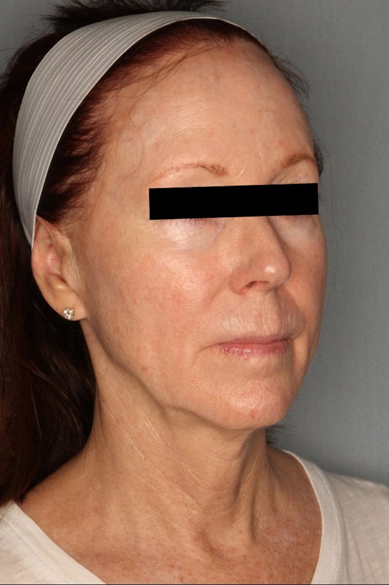 Halo Laser Before & After Gallery - Patient 55475022 - Image 4