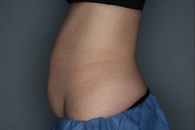 CoolSculpting Before & After Gallery - Patient 55475021 - Image 1