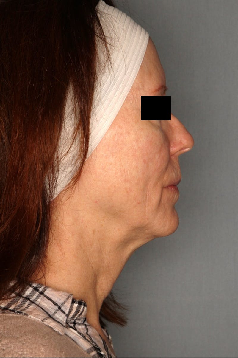 Halo Laser Before & After Gallery - Patient 55475022 - Image 5