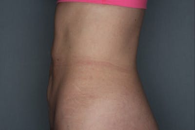 CoolSculpting Before & After Gallery - Patient 55475021 - Image 2