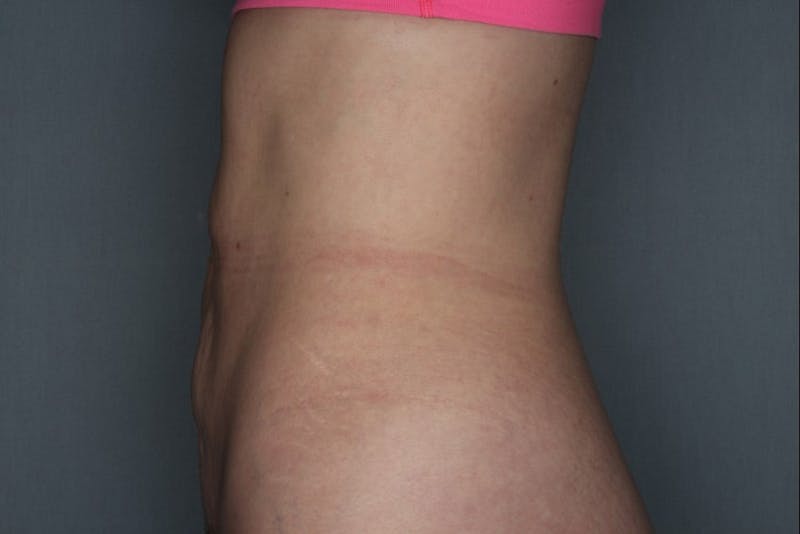 CoolSculpting Before & After Gallery - Patient 55475021 - Image 2