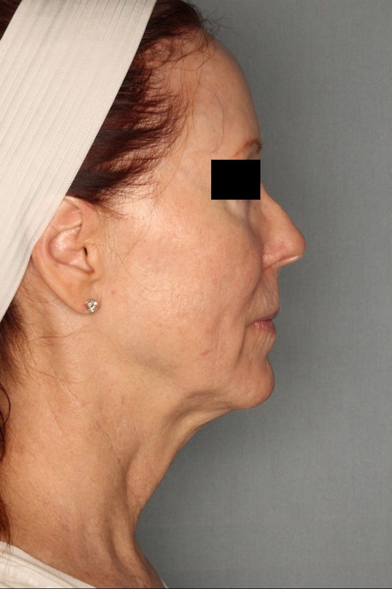 Halo Laser Before & After Gallery - Patient 55475022 - Image 6