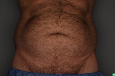 CoolSculpting Before & After Gallery - Patient 55475023 - Image 1
