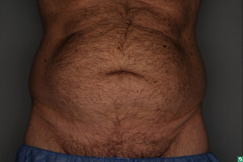 CoolSculpting Before & After Gallery - Patient 55475023 - Image 1
