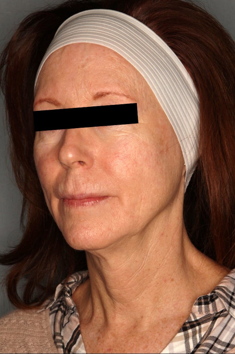 Halo Laser Before & After Gallery - Patient 55475022 - Image 7