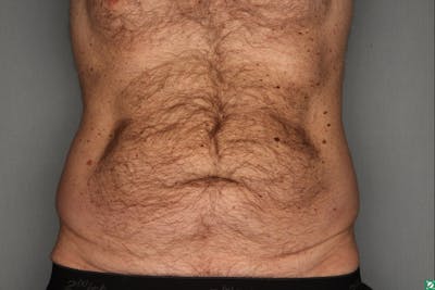 CoolSculpting Before & After Gallery - Patient 55475023 - Image 2