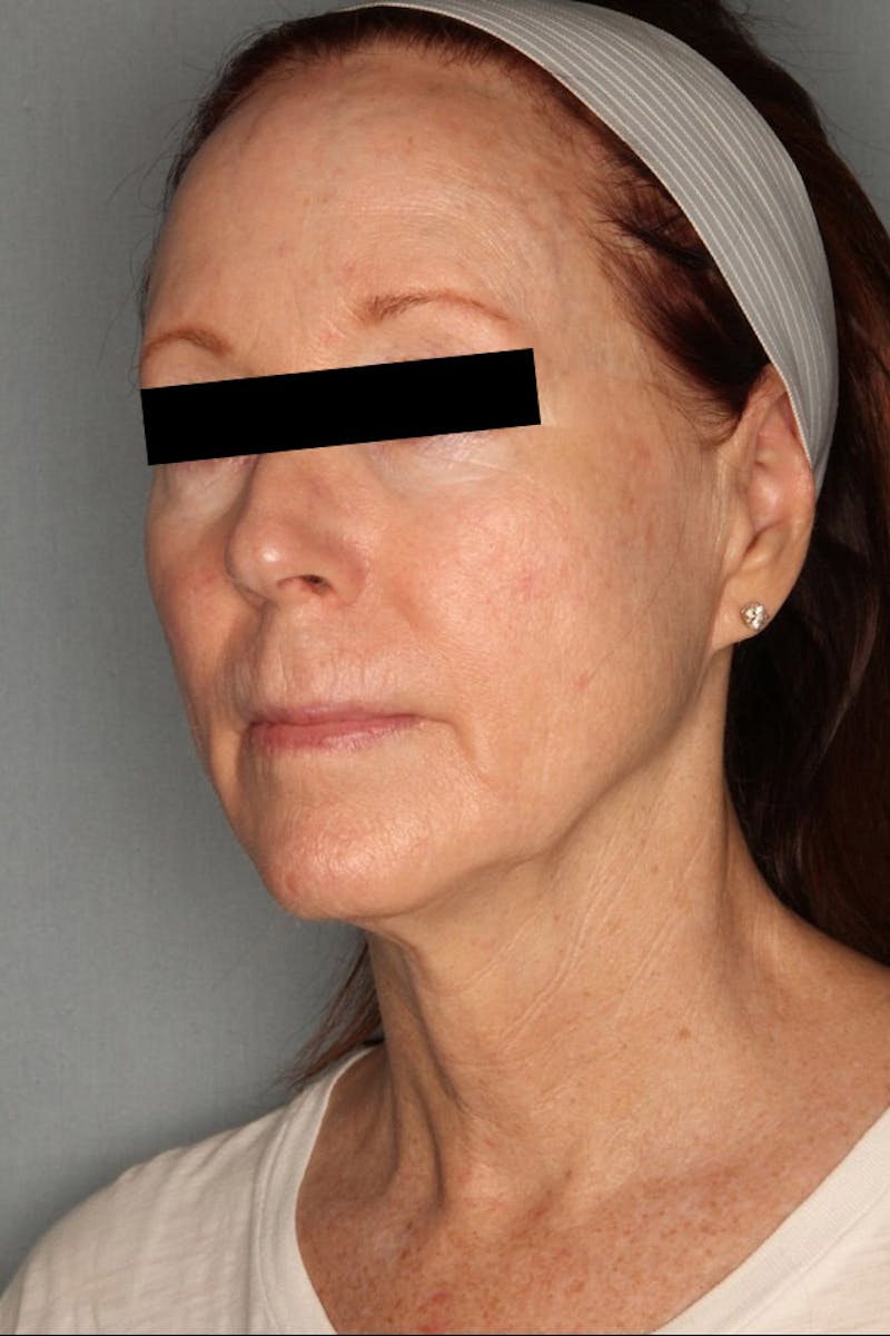 Halo Laser Before & After Gallery - Patient 55475022 - Image 8