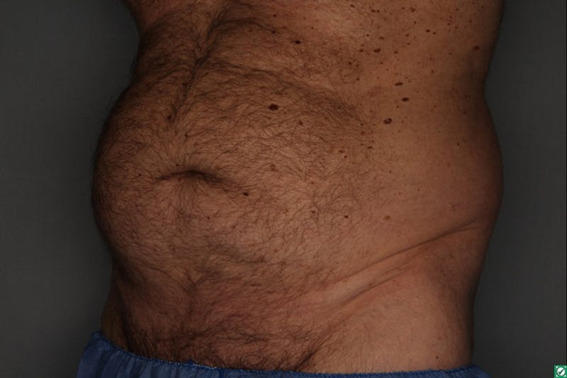 CoolSculpting Before & After Gallery - Patient 55475023 - Image 3