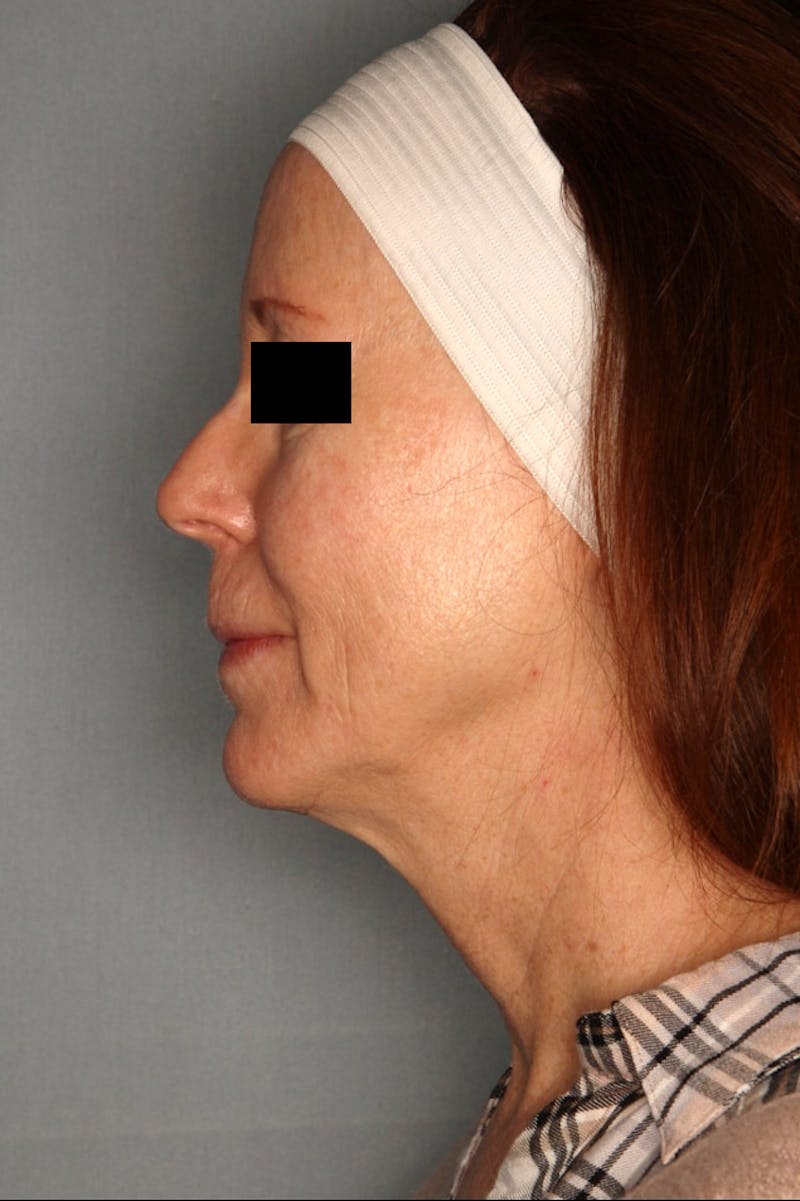 Halo Laser Before & After Gallery - Patient 55475022 - Image 9
