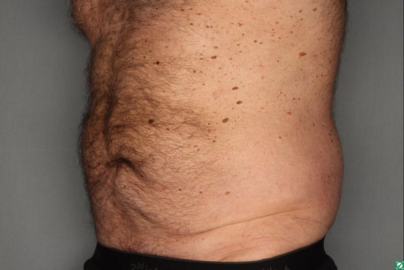 CoolSculpting Before & After Gallery - Patient 55475023 - Image 4
