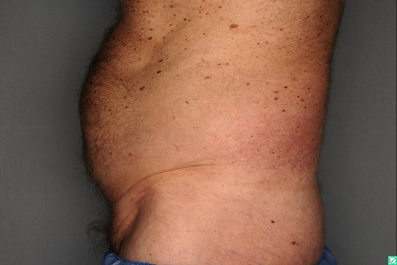CoolSculpting Before & After Gallery - Patient 55475023 - Image 5