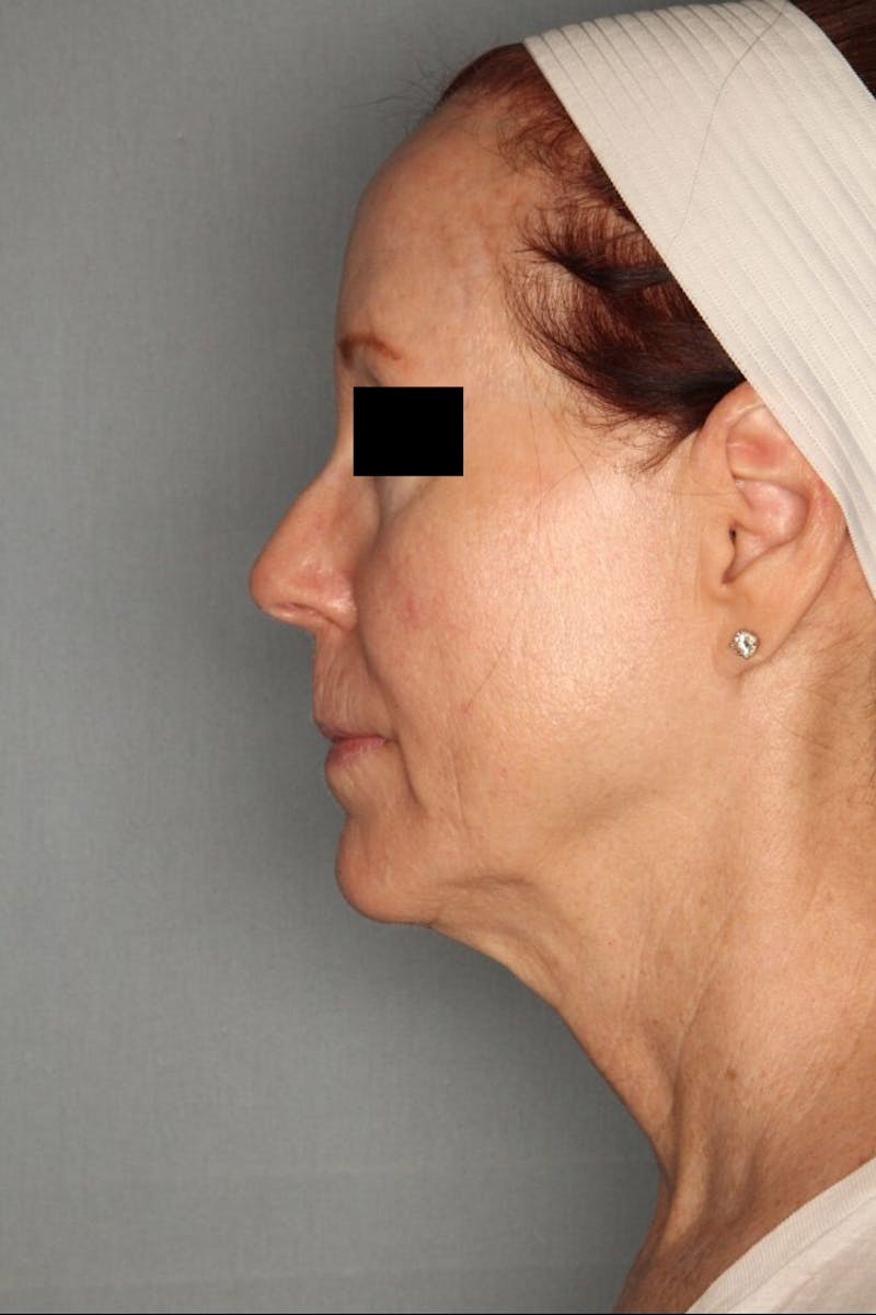 Halo Laser Before & After Gallery - Patient 55475022 - Image 10