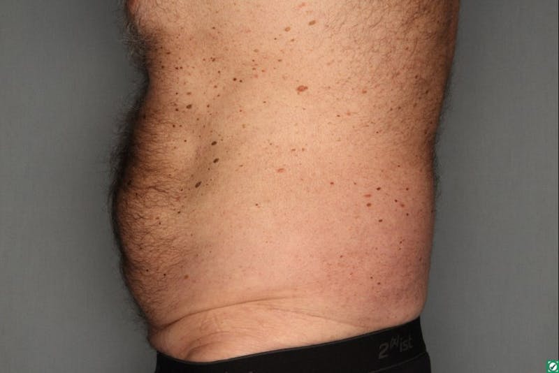 CoolSculpting Before & After Gallery - Patient 55475023 - Image 6