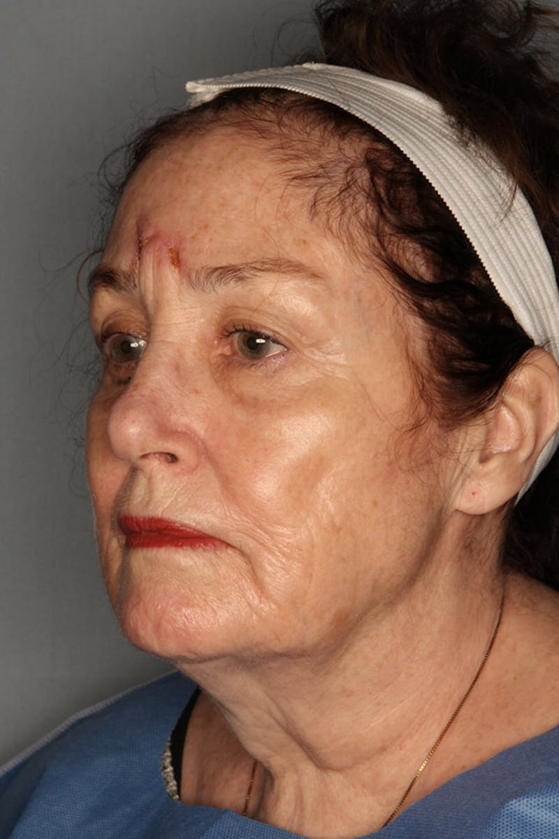 Halo Laser Before & After Gallery - Patient 55475026 - Image 1