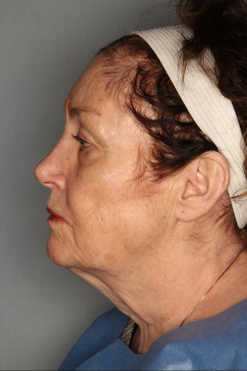 Halo Laser Before & After Gallery - Patient 55475026 - Image 3