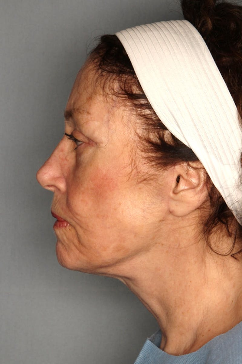 Halo Laser Before & After Gallery - Patient 55475026 - Image 4