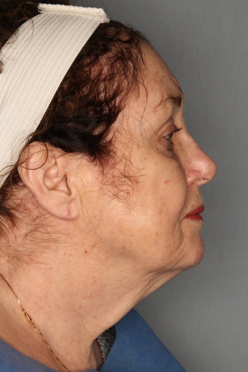 Halo Laser Before & After Gallery - Patient 55475026 - Image 5