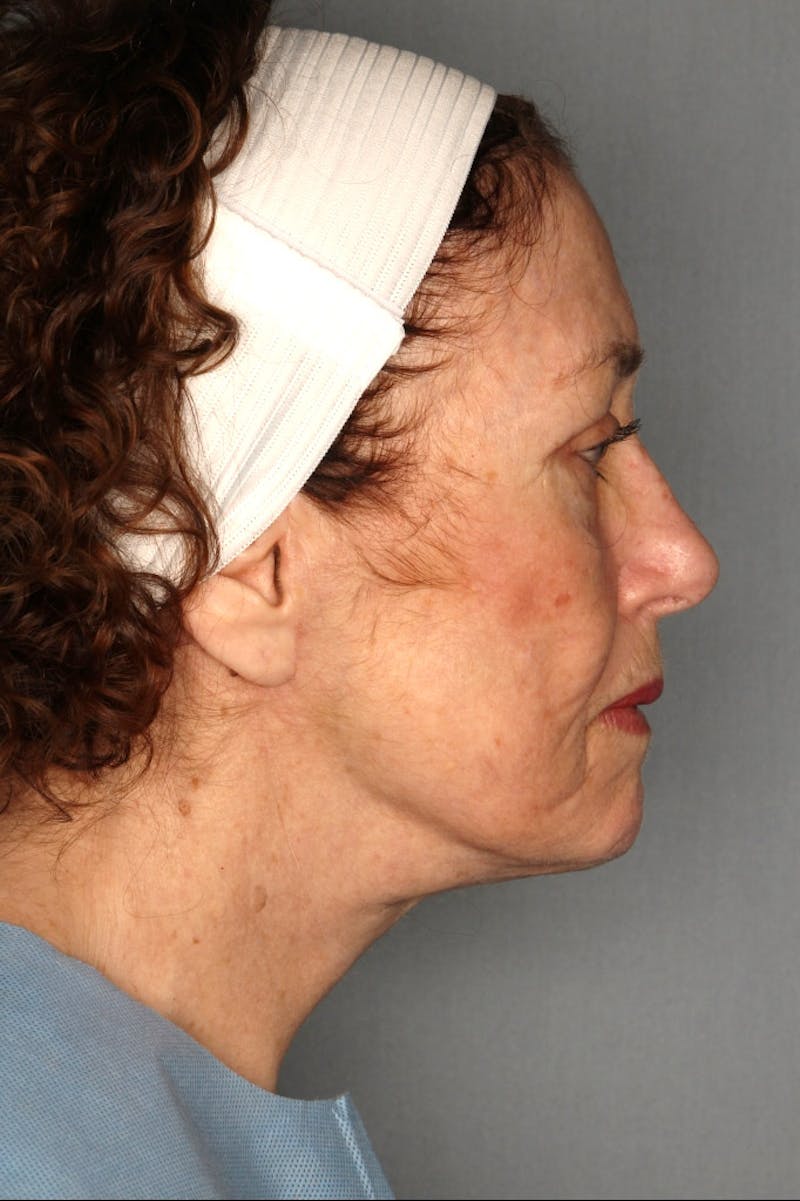 Halo Laser Before & After Gallery - Patient 55475026 - Image 6