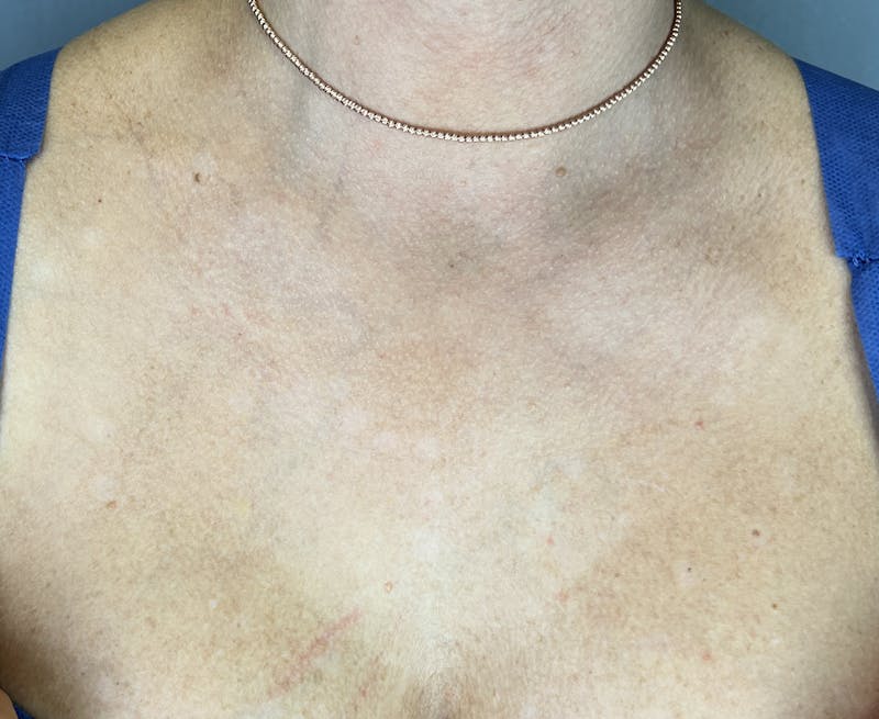 Halo Laser Before & After Gallery - Patient 285128 - Image 4