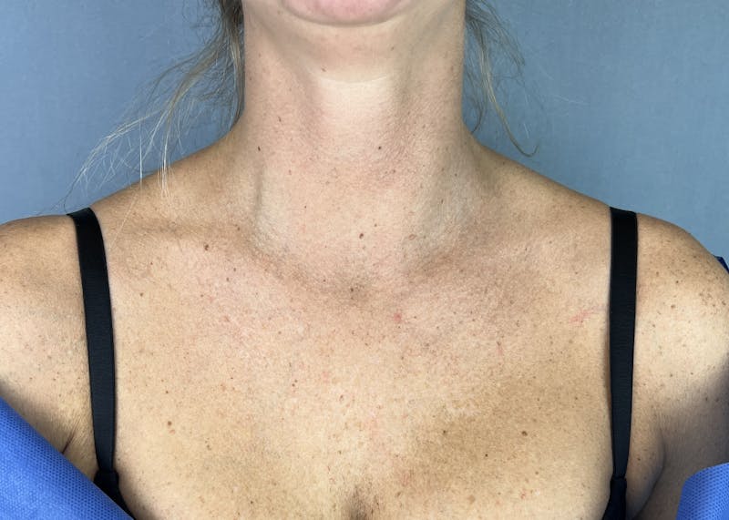 Halo Laser Before & After Gallery - Patient 285128 - Image 3