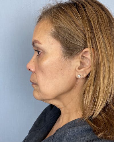 Facelift Before & After Gallery - Patient 270896 - Image 1