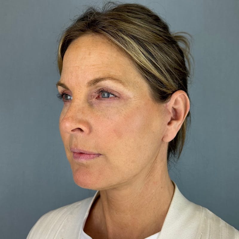 Facelift Before & After Gallery - Patient 337012 - Image 2