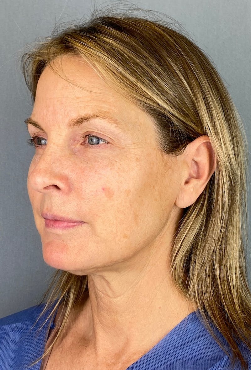 Facelift Before & After Gallery - Patient 337012 - Image 1
