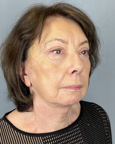 Facelift Before & After Gallery - Patient 390602 - Image 2