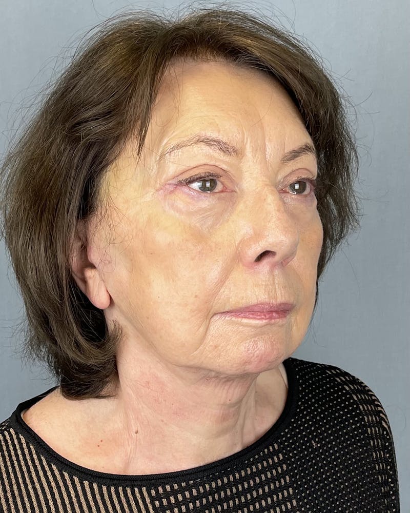 Facelift Before & After Gallery - Patient 390602 - Image 2