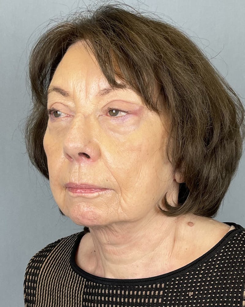 Facelift Before & After Gallery - Patient 390602 - Image 4