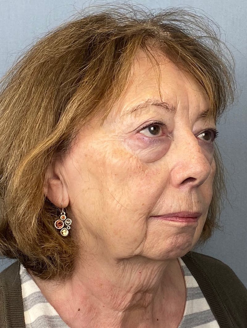 Facelift Before & After Gallery - Patient 390602 - Image 1