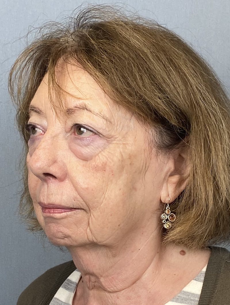 Facelift Before & After Gallery - Patient 390602 - Image 3