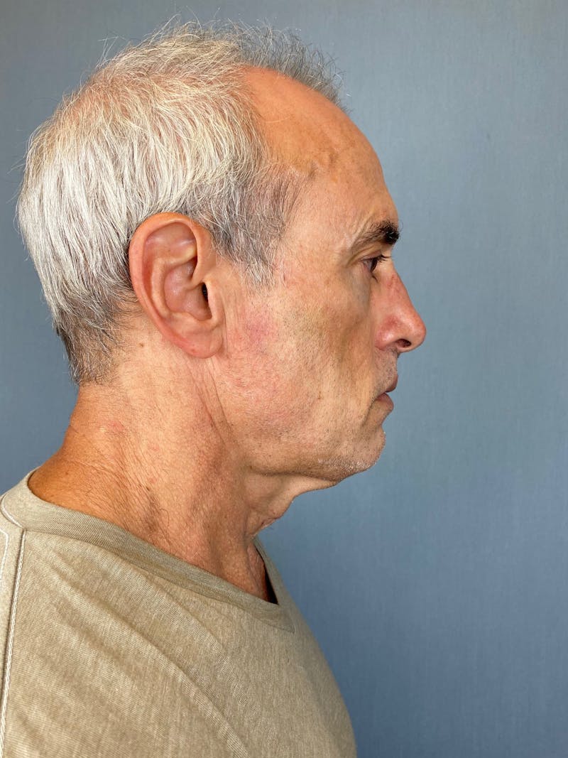 Facelift Before & After Gallery - Patient 412859 - Image 1