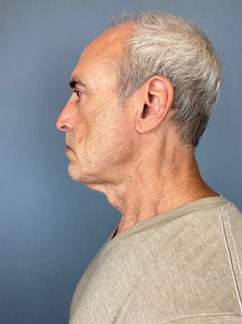 Facelift Before & After Gallery - Patient 412859 - Image 3