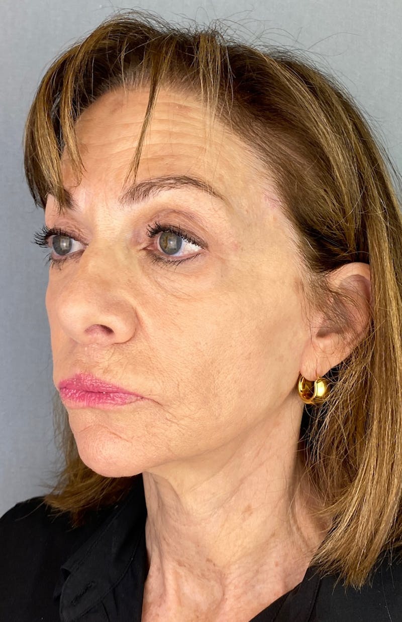 Lip Lift Before & After Gallery - Patient 280650 - Image 2