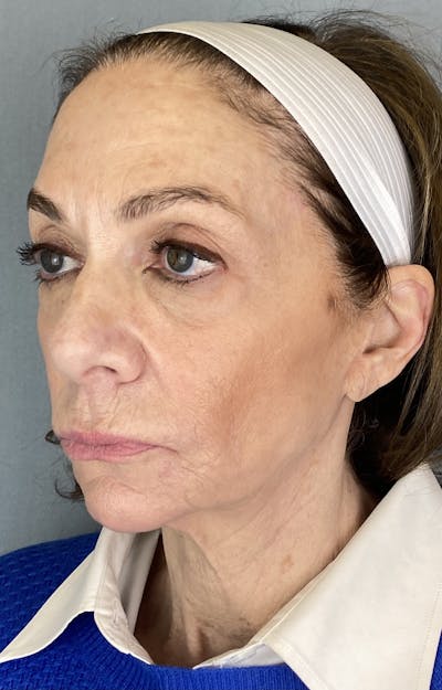 Lip Lift Before & After Gallery - Patient 280650 - Image 1