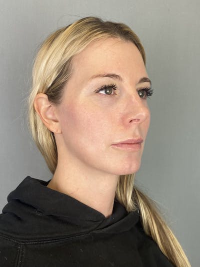 Blepharoplasty Before & After Gallery - Patient 117241 - Image 2