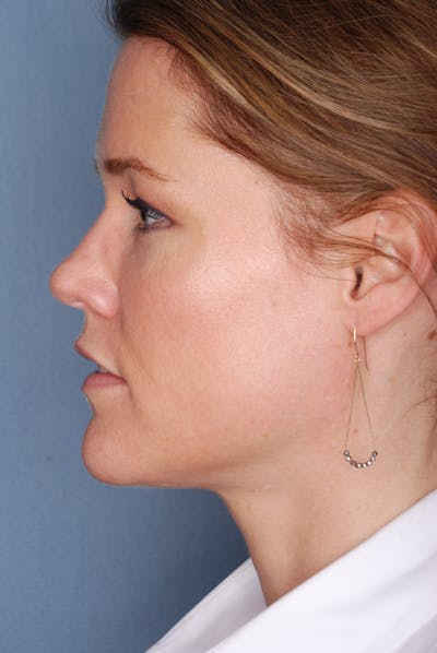 Ultherapy Before & After Gallery - Patient 985990 - Image 2