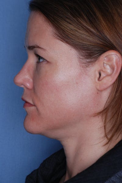 Ultherapy Before & After Gallery - Patient 985990 - Image 1