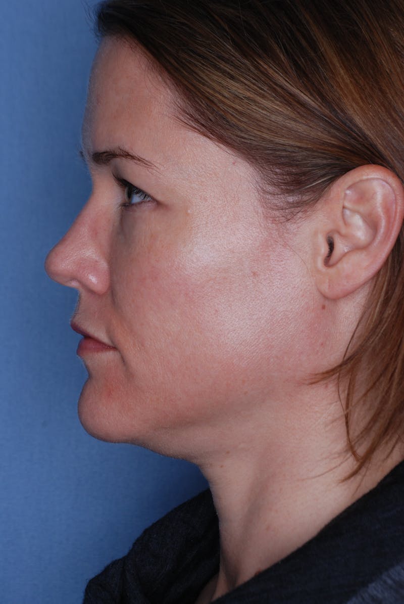 Ultherapy Before & After Gallery - Patient 985990 - Image 1