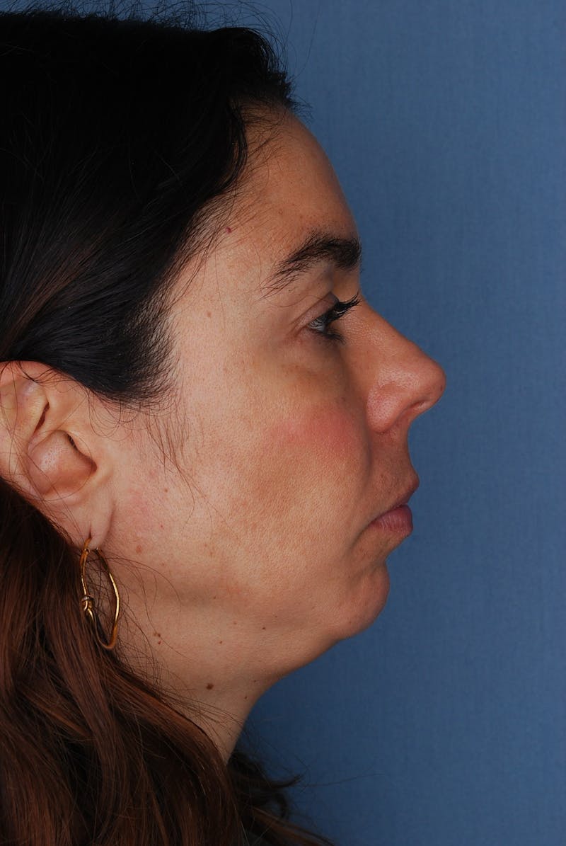 Ultherapy Before & After Gallery - Patient 660948 - Image 1