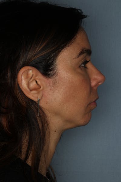 Ultherapy Before & After Gallery - Patient 660948 - Image 2