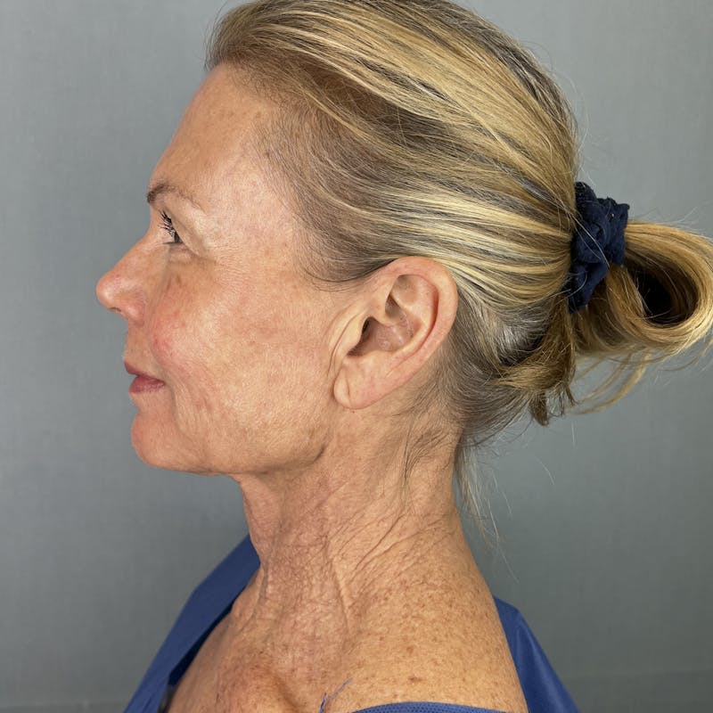 Ultherapy Before & After Gallery - Patient 143000 - Image 2
