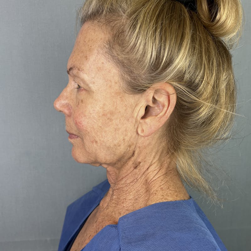 Ultherapy Before & After Gallery - Patient 143000 - Image 1
