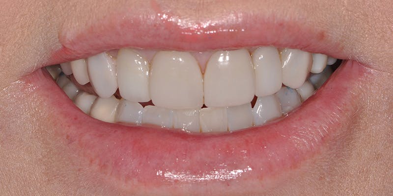 Patient Results Before & After Gallery - Patient 301566 - Image 1