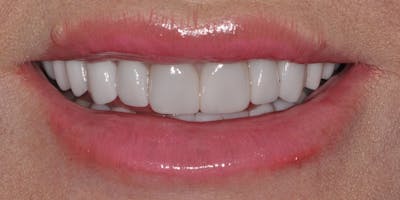 Patient Results Before & After Gallery - Patient 301566 - Image 2