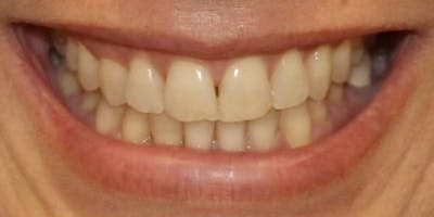 Patient Results Before & After Gallery - Patient 415892 - Image 1