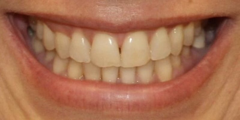 Patient Results Before & After Gallery - Patient 415892 - Image 1