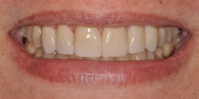 Patient Results Before & After Gallery - Patient 415892 - Image 2